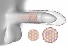 Augmentation du pénis en volume